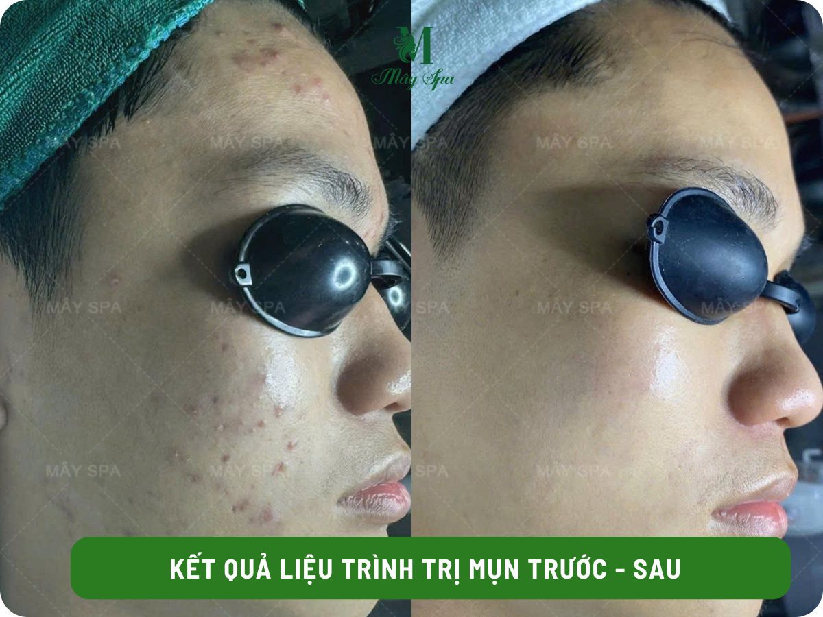 Kết quả điều trị mụn sau 1 liệu tr&igrave;nh tại M&acirc;y spa