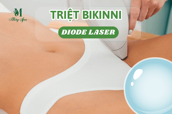 Khách hàng triệt bikini hiệu quả với công nghệ Diode Laser