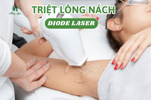 Khách hàng đang triệt lông nách bằng công nghệ Diode Laser chuẩn y khoa