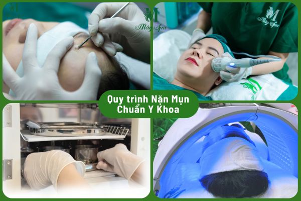 Quy tr&igrave;nh nặn mụn chuẩn y khoa tại T&acirc;n Ph&uacute;