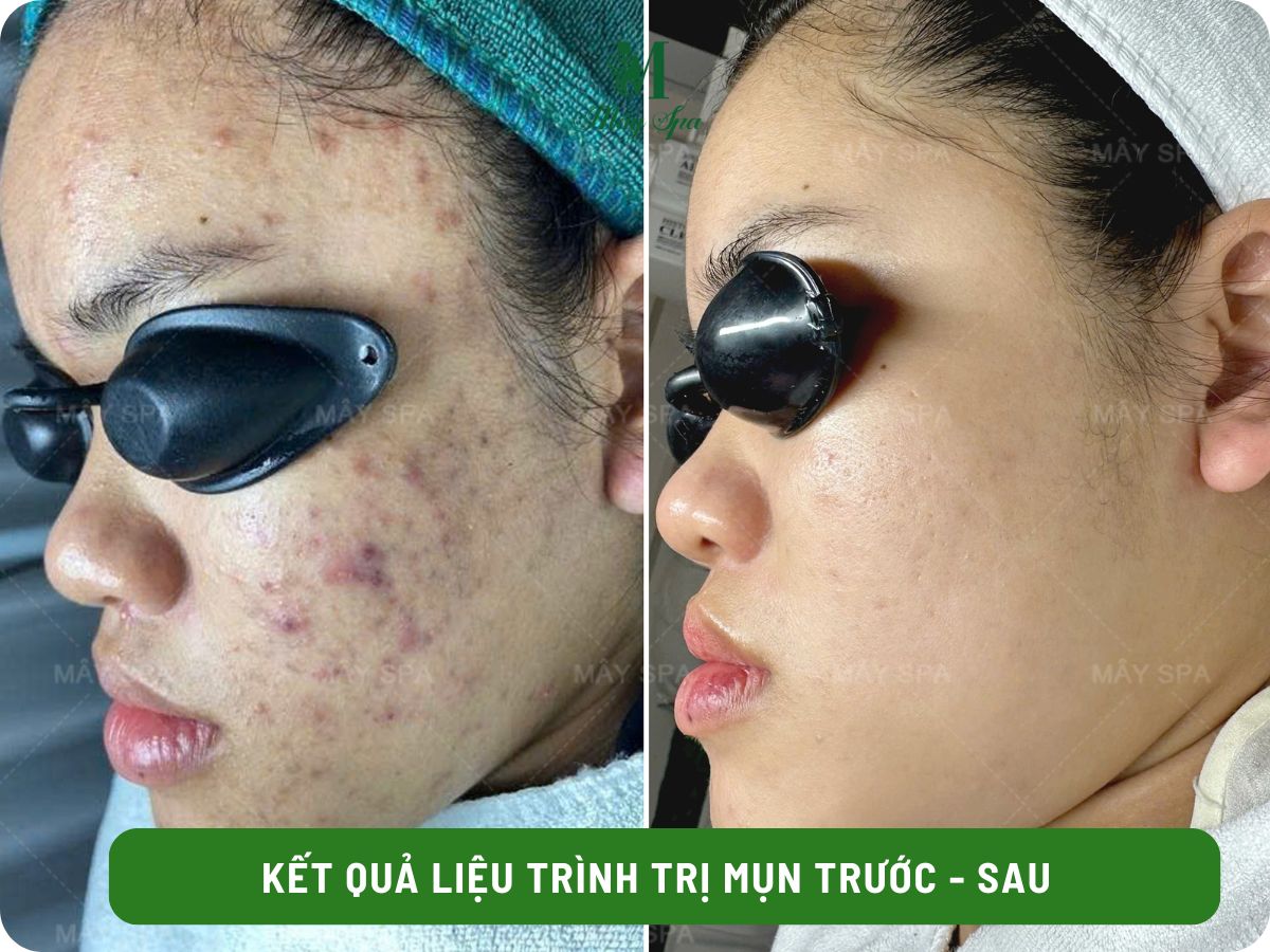 Kết quả điều trị mụn sau 1 liệu tr&igrave;nh tại M&acirc;y spa