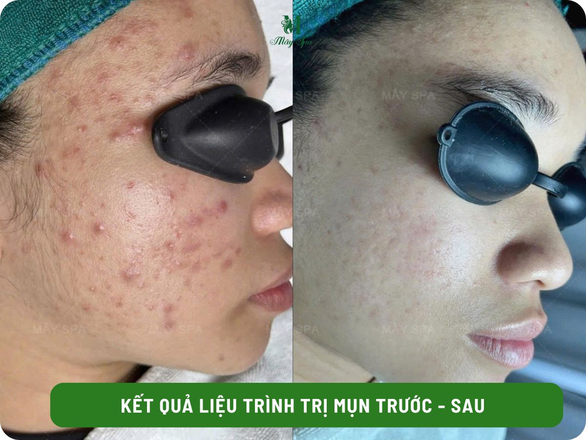 Kết quả điều trị mụn sau 1 liệu tr&igrave;nh tại M&acirc;y spa