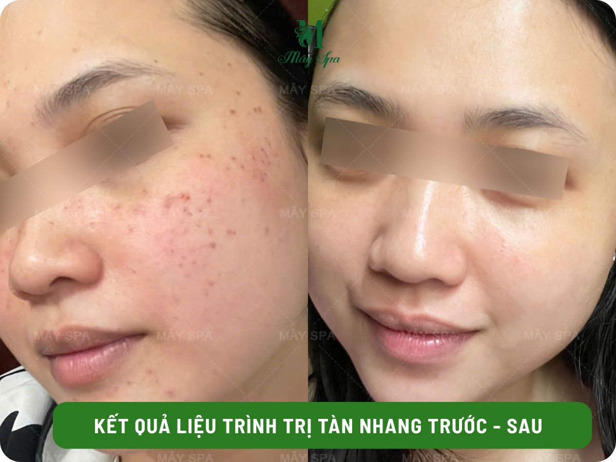 Kết quả điều trị mụn sau 1 liệu tr&igrave;nh tại M&acirc;y spa