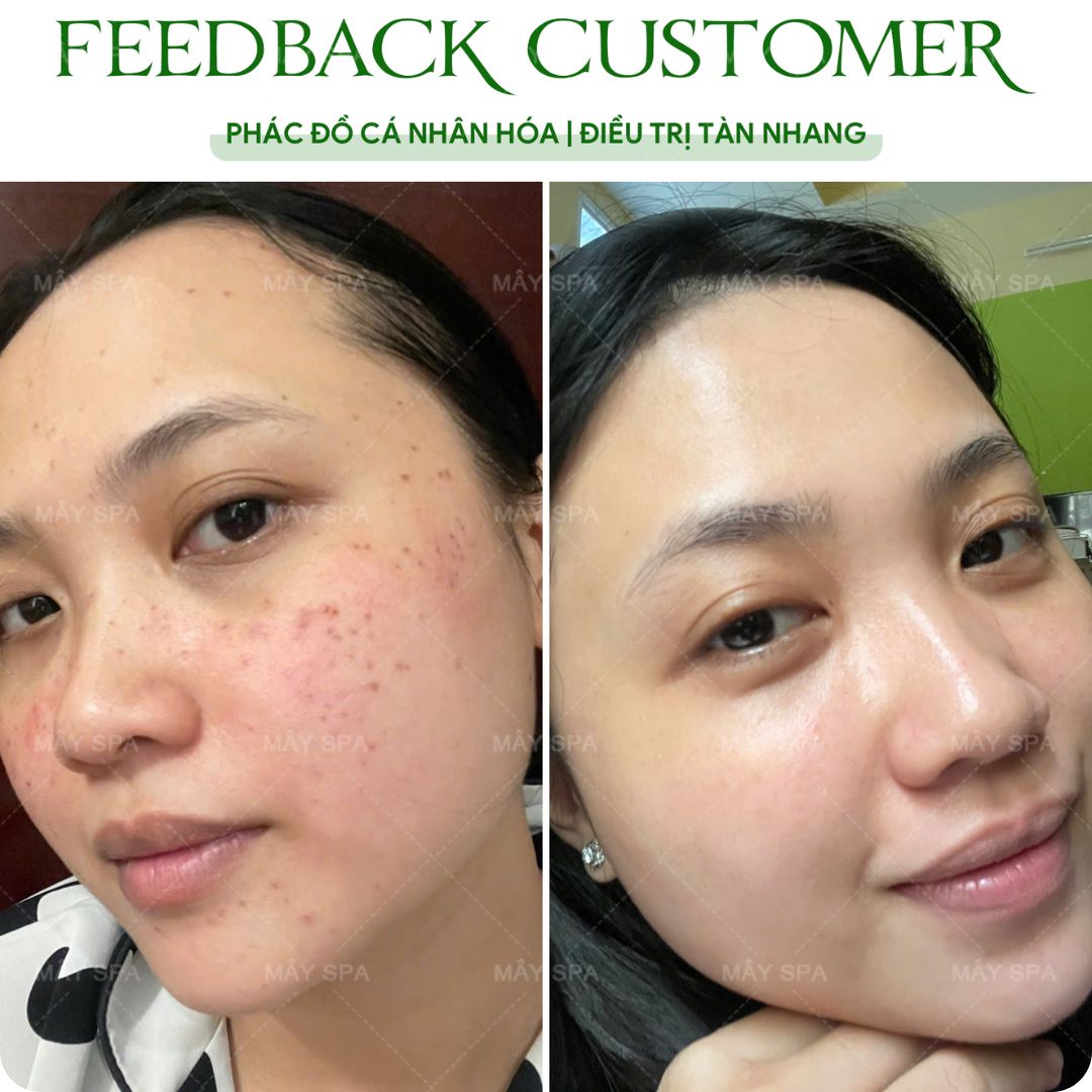 Hình ảnh trước và sau peel da trị tàn nhang tại Mây Spa Tân Phú