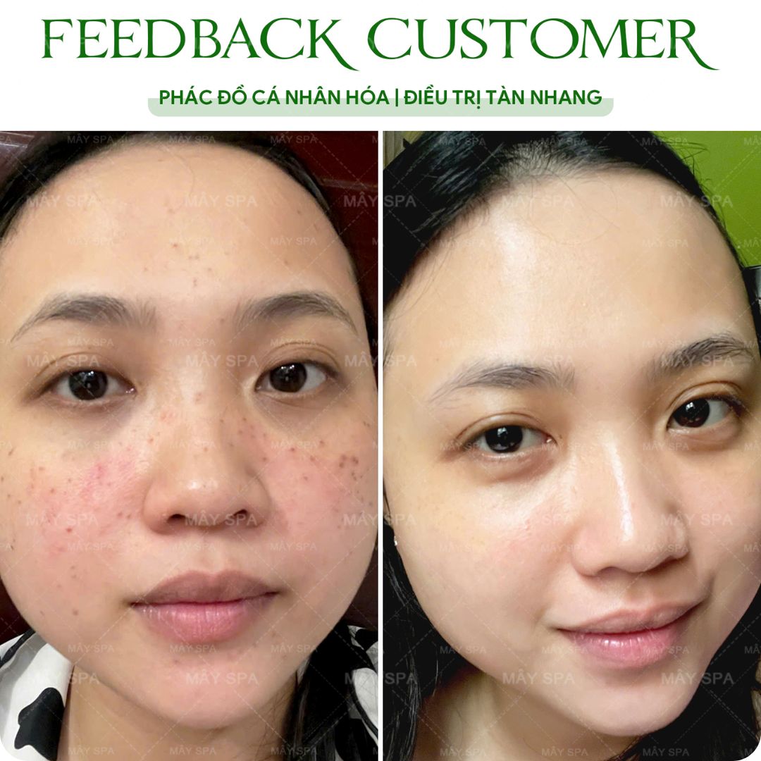 Hình ảnh trước và sau peel da trị tàn nhang tại Mây Spa Tân Phú