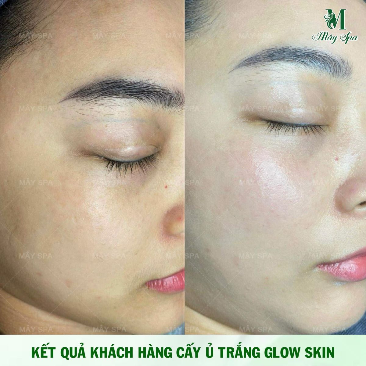 Kết quả của khách hàng sử dụng dịch vụ cấy trắng Glowing Skin tại Mây spa