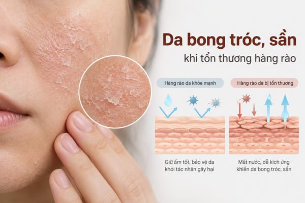 Da bong tróc và sần là dấu hiệu hàng rào bảo vệ da suy yếu