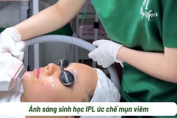 Trị mụn IPL hiệu quả đối với mụn viêm