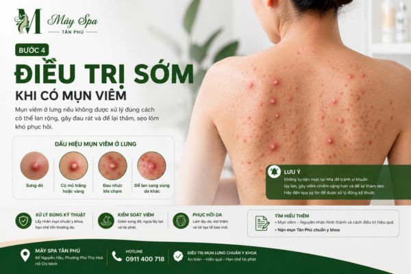 Mụn vi&ecirc;m ở lưng cần điều trị đ&uacute;ng c&aacute;ch