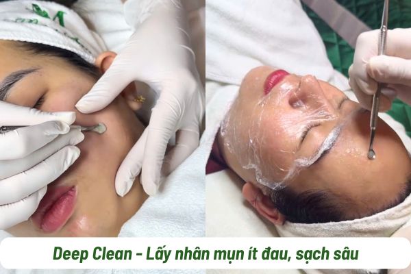 dịch vụ trị mụn deep clean tại spa Tân Phú giá 320k