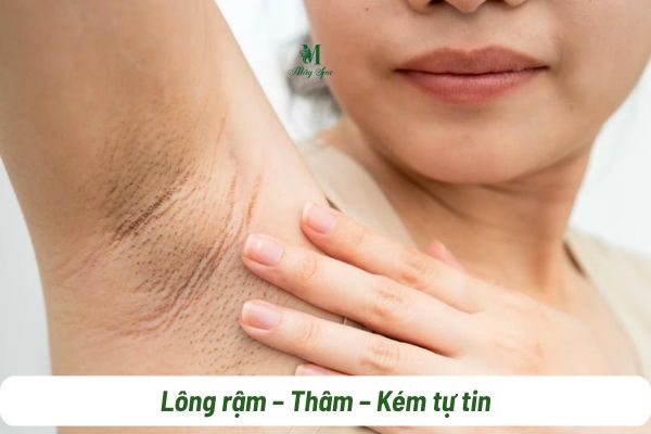 l&ocirc;ng n&aacute;ch bikini g&acirc;y mất tự tin