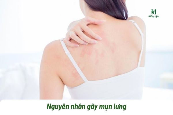 Nguy&ecirc;n nh&acirc;n g&acirc;y mụn lưng