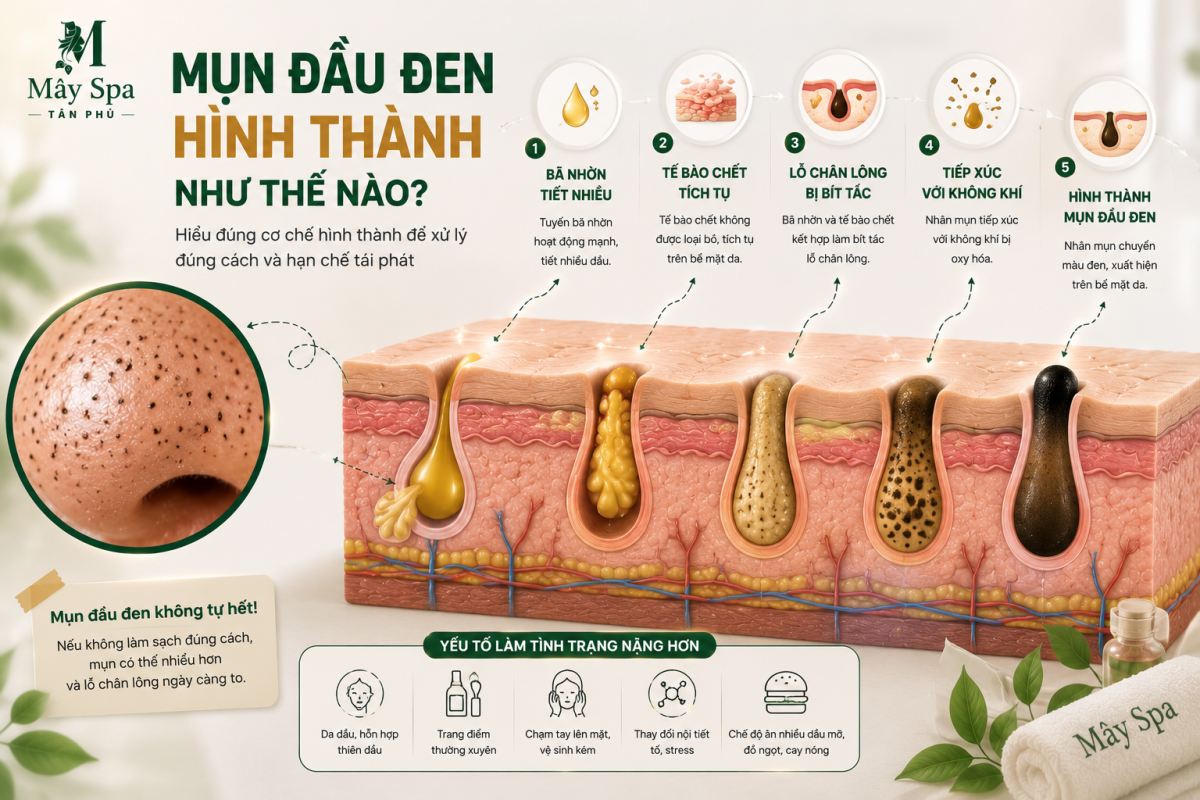 Nguy&ecirc;n nh&acirc;n h&igrave;nh th&agrave;nh mụn đầu đen