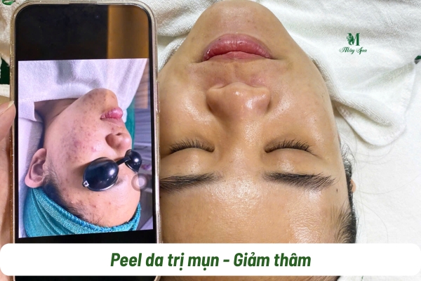 Peel da trị mụn, trị th&acirc;m hiệu quả 