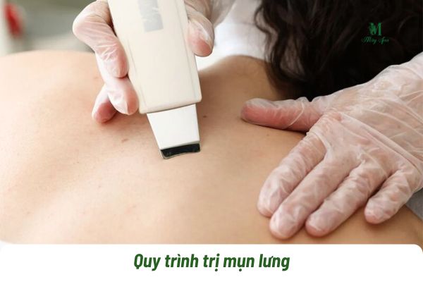quy tr&igrave;nh trị mụn lưng tại spa