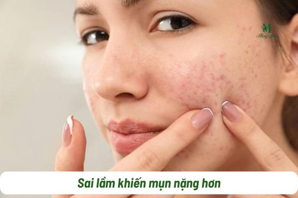 sai lầm trị mụn viêm của gen z