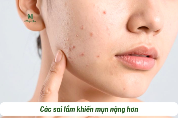 Sai lầm trị mụn phổ biến