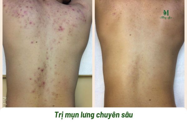 spa trị mụn lưng tphcm