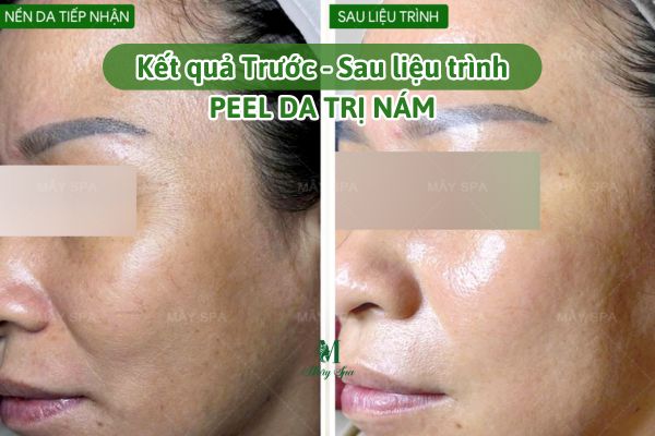 so s&aacute;nh trước v&agrave; sau peel da trị n&aacute;m kết hợp phục hồi da tại spa