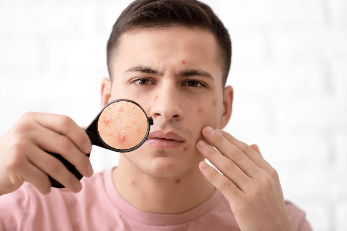 Skincare cho nam bị mụn và Routine hiệu quả
