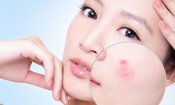 Chăm sóc da mụn nhạy cảm để tránh kích ứng gây thâm đỏ hoặc bùng phát mụn