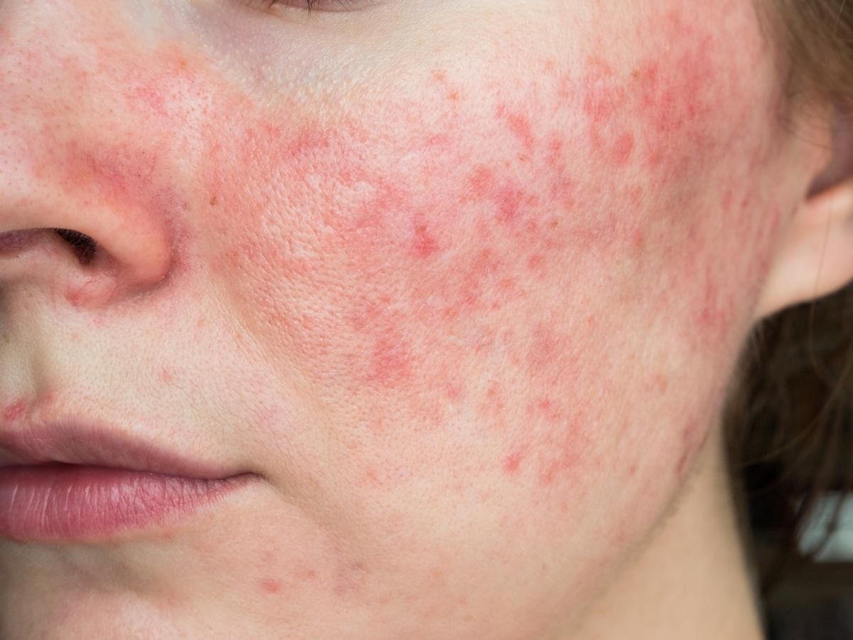 Da k&iacute;ch ứng mỹ phẩm