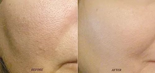 Điều trị lỗ chân lông to tại Mây spa