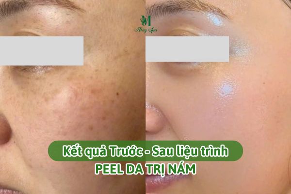 so s&aacute;nh trước v&agrave; sau peel da trị n&aacute;m kết hợp phục hồi da tại spa