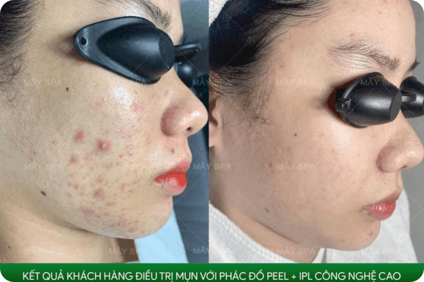 Kh&aacute;ch h&agrave;ng đ&aacute;nh gi&aacute; hiệu quả combo nặn mụn IPL tại M&acirc;y Spa