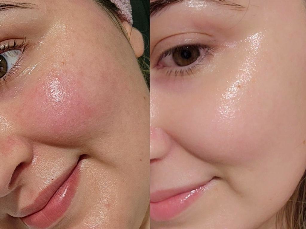 Kết quả sau liệu tr&igrave;nh căng b&oacute;ng da tại M&acirc;y spa
