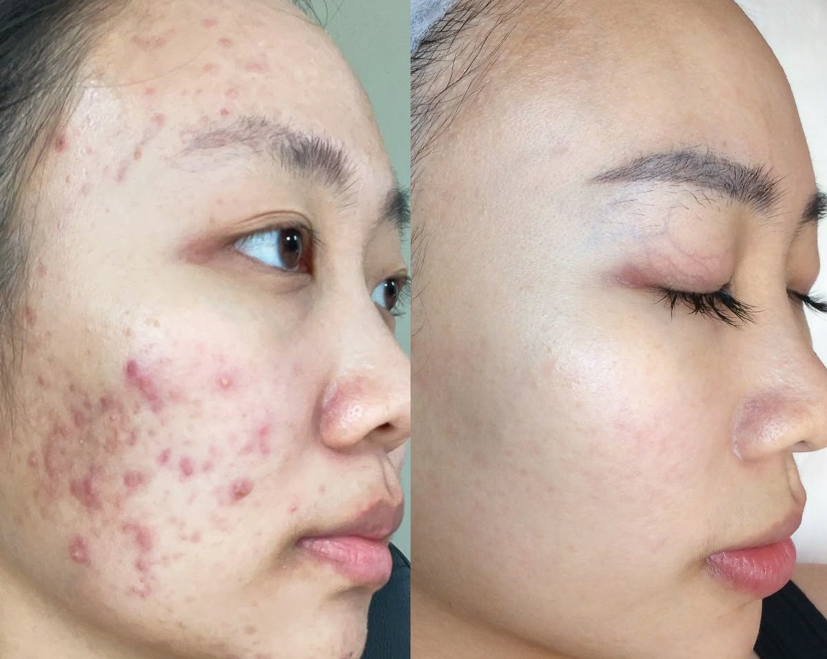 Peel chuẩn y khoa kết hợp chăm sóc da đúng cách sẽ giúp da luôn khỏe và sạch mụn từ bên trong