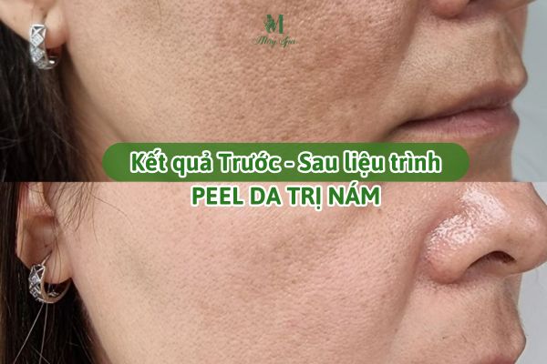 so s&aacute;nh trước v&agrave; sau peel da trị n&aacute;m kết hợp phục hồi da tại spa