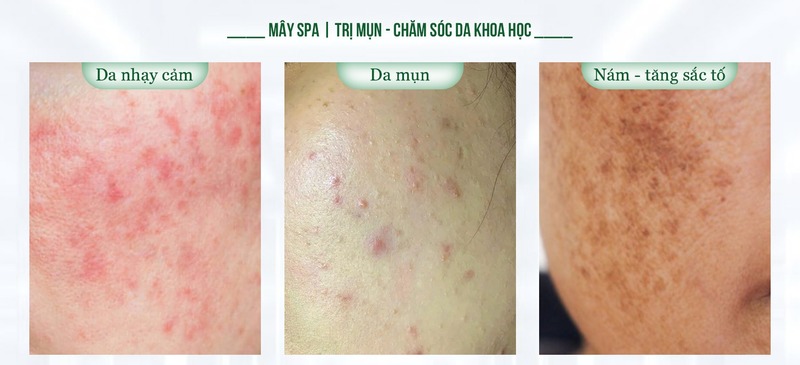 C&aacute;c liệu tr&igrave;nh phục hồi da tại M&acirc;y spa T&acirc;n Ph&uacute;