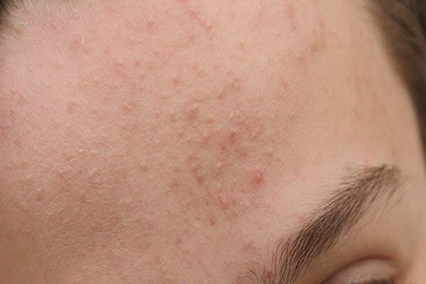 Mụn ẩn thường nằm sâu dưới da, không có đầu mụn trồi lên rõ ràng