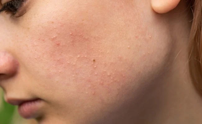 Mụn ẩn thường khó quan sát rõ ràng bằng mắt thường