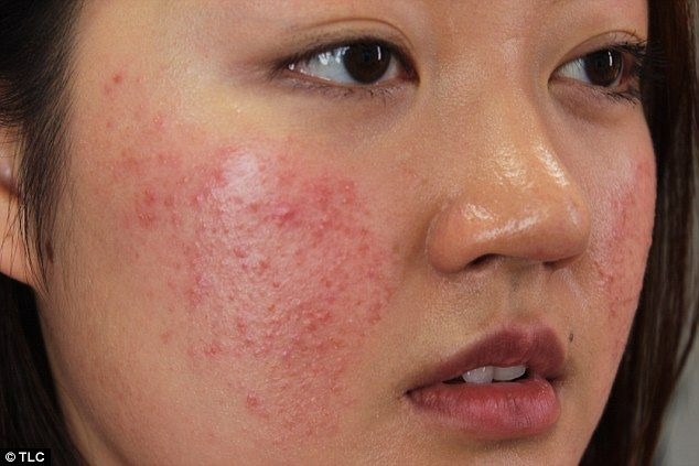 10 điều quan trọng nhất về mụn tuổi dậy thì cần nắm rõ