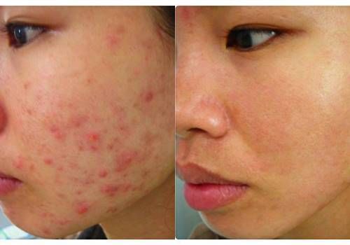 Mụn dậy thì luôn là nỗi ám ảnh của học sinh lẫn huynh