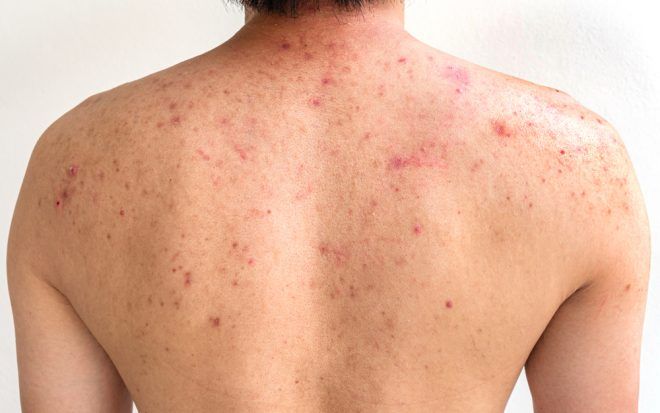 Mụn lưng và Nguyên nhân gây mụn lưng