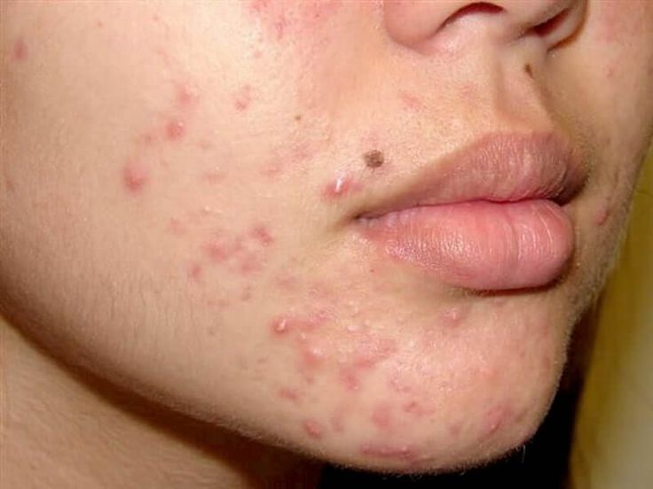 Lấy nhân mụn chuẩn y khoa tại spa sẽ hạn chế để lại thâm sẹo và biến chứng