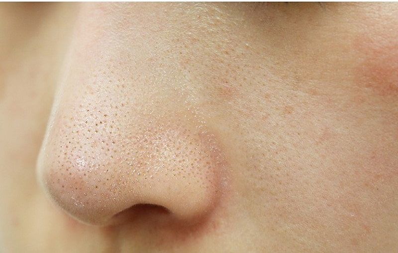 Mụn trứng c&aacute; dễ g&acirc;y vi&ecirc;m, sưng, đỏ