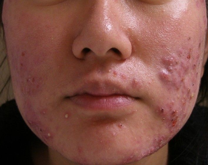 Nền da yếu hoặc viêm