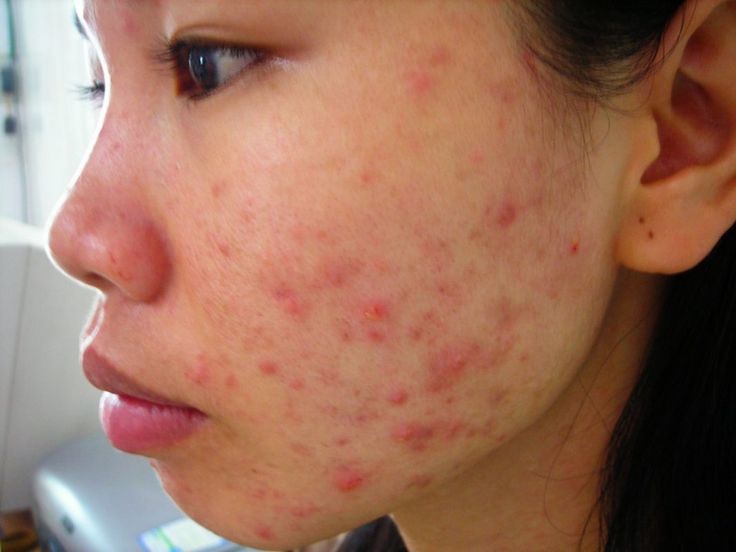 Mụn viêm - Nỗi ám ảnh của nhiều người
