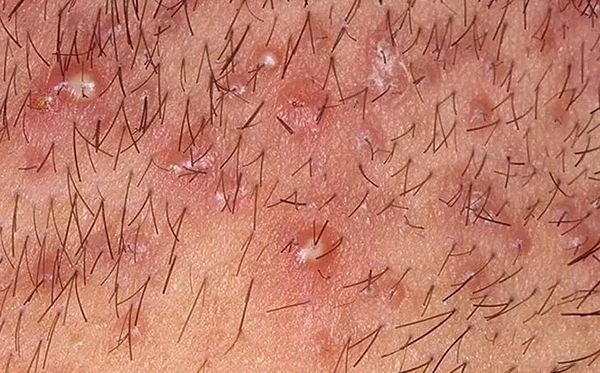 Mụn viêm nang lông do cạo râu