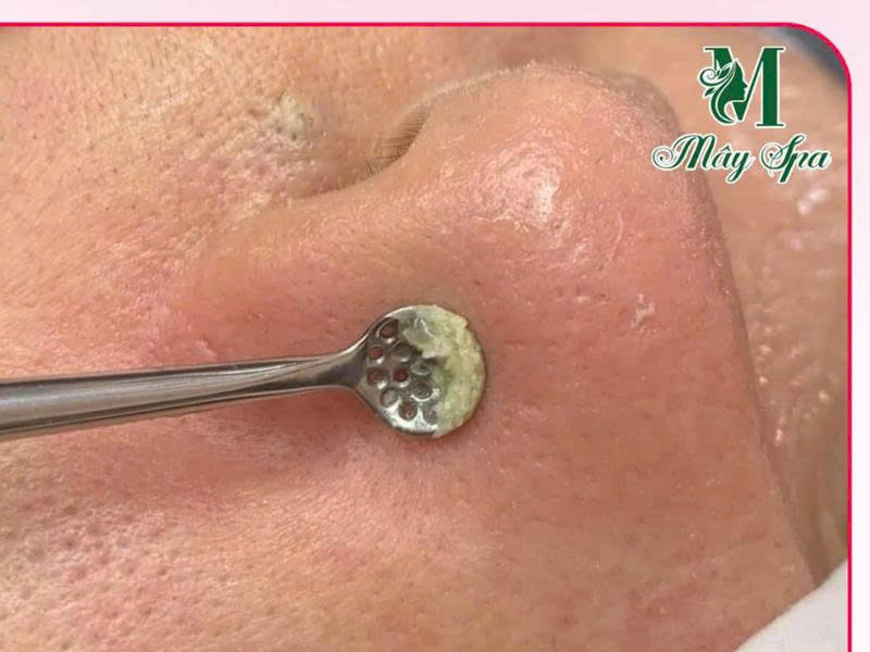 Nặn mụn không đau Deep Clean Skin