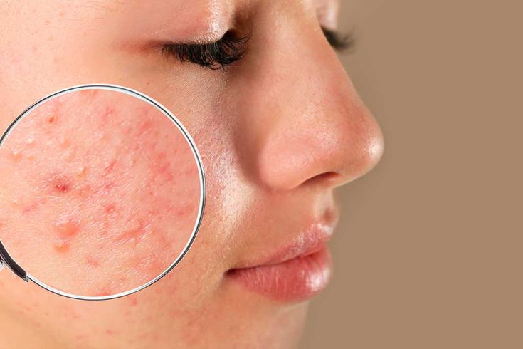 Chăm sóc da mụn là nhu cầu thiết yếu kể cả cho học sinh, sinh viên