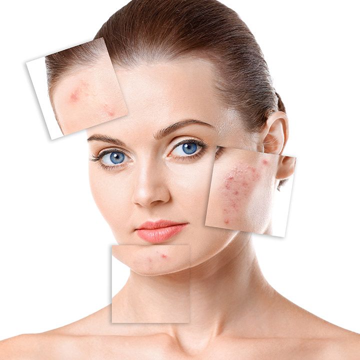 Peel da trị mụn - Chăm sóc da mụn chuẩn y khoa tại spa