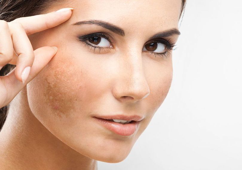 Peel da trị n&aacute;m, giải ph&aacute;p an to&agrave;n cho da sạm, n&aacute;m nhẹ
