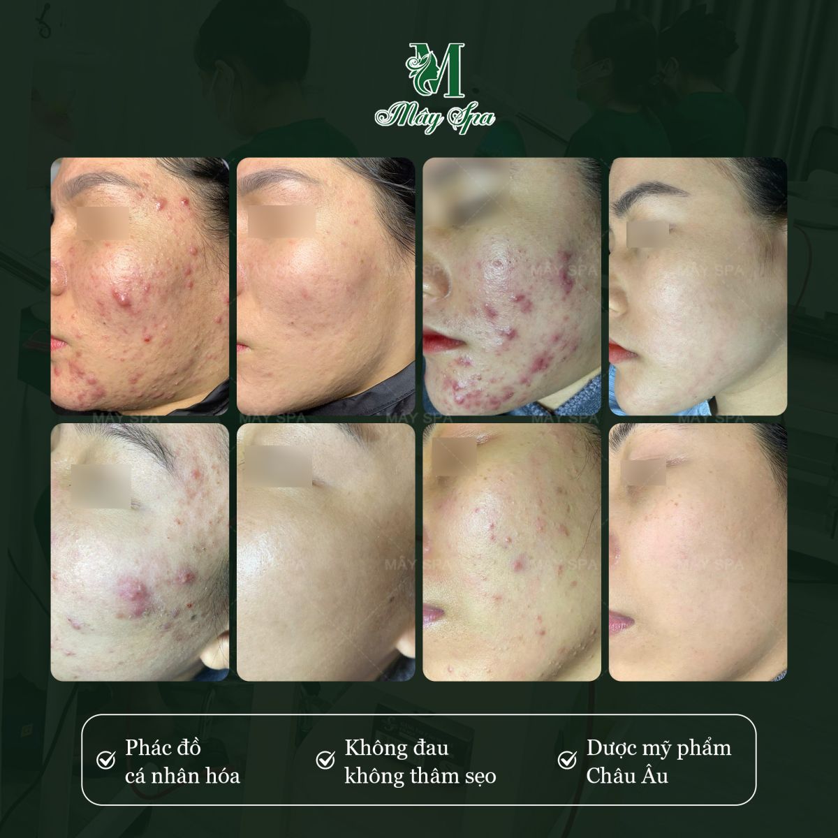 Phác đồ điều trị mụn cá nhân hóa sẽ giúp bạn lấy lại " thanh xuân " cho làn da