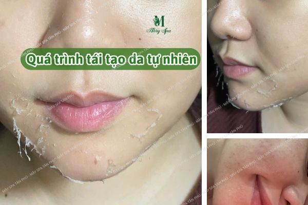 t&igrave;nh trạng bong nhẹ sau peel da trị n&aacute;m, phản ứng t&aacute;i tạo sinh l&yacute; của da