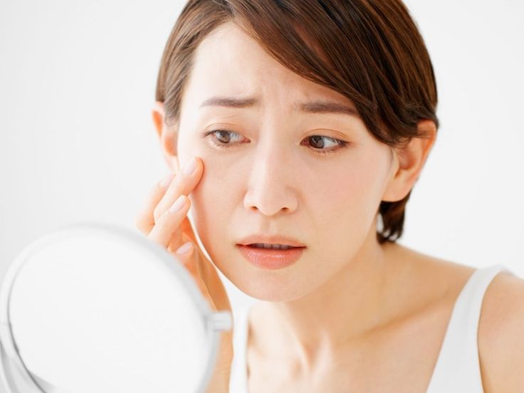 Da tăng sắc tố sẽ trờ n&ecirc;n sẫm m&agrave;u, dẫn đến t&agrave;n nhang, n&aacute;m hoặc da kh&ocirc;ng đều m&agrave;u